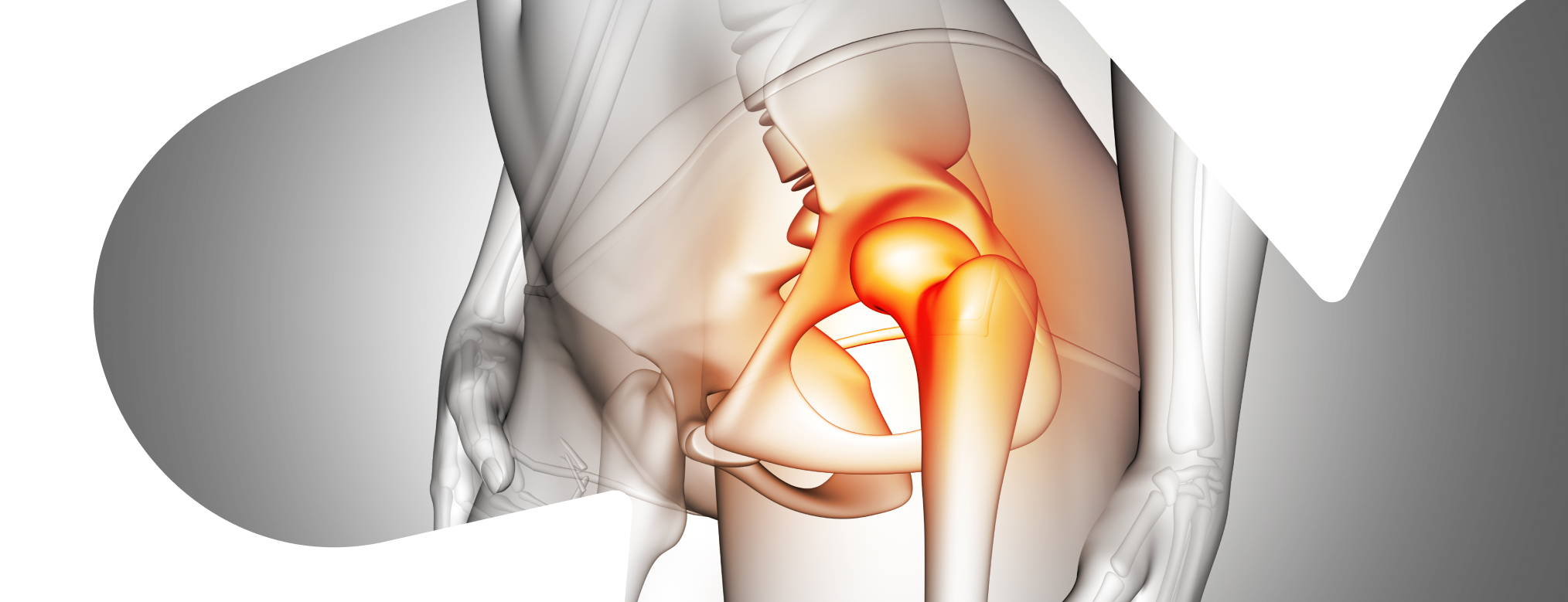 Симптомы перелома бедренной кости