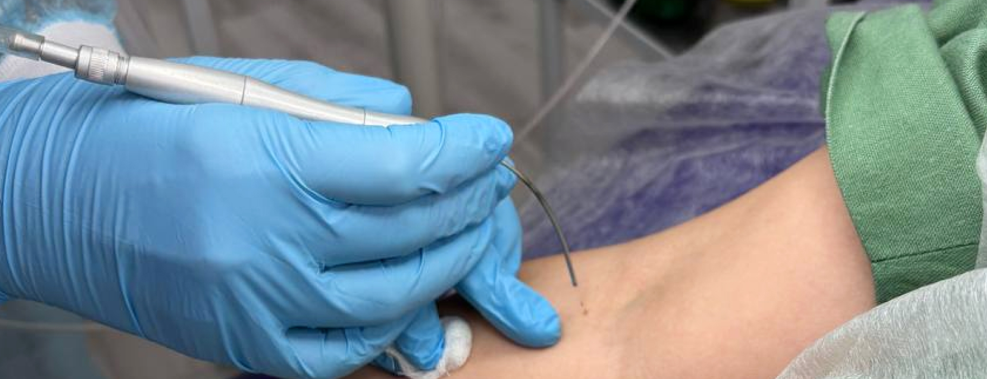 Лечение папилломы